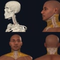 How common is vertebral artery dissection from chiropractor?