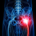 Can nerve pain get worse after chiropractor?