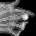 Can an xray show signs of arthritis?