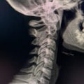 Can a chiropractor see arthritis on xray?