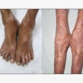 What disease can be mistaken for arthritis?