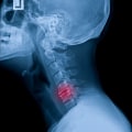Can a chiropractor mess up your neck?