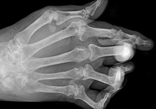 Can an xray show signs of arthritis?