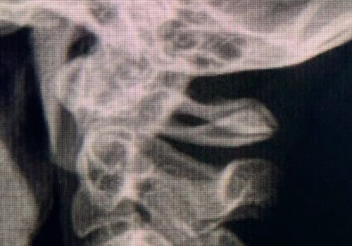 Can a chiropractor see arthritis on xray?