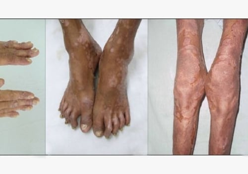 What disease can be mistaken for arthritis?