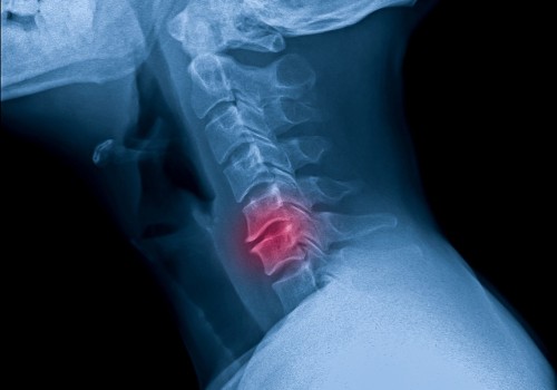 Can a chiropractor mess up your neck?
